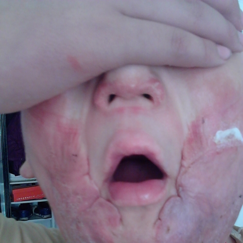 12歲的孩子面部燒傷疤痕增生可以打疤痕針嗎？[tag]