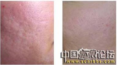 青春痘疤痕如何進(jìn)行修復(fù)[tag]