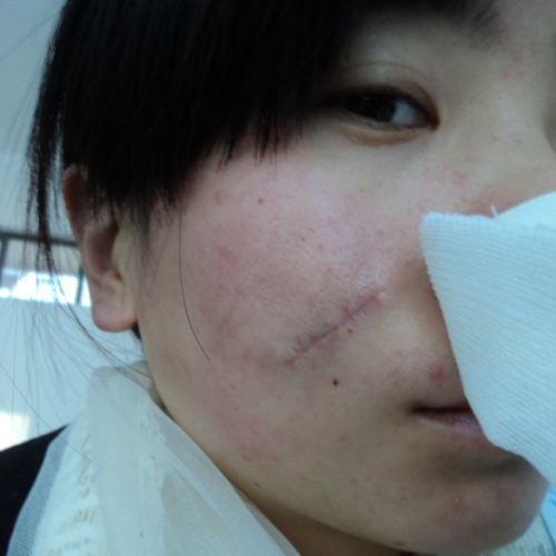 今天是術后第二個月第十一天[tag]