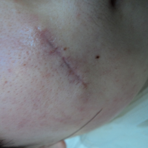 今天是術后第二個月第十一天[tag]