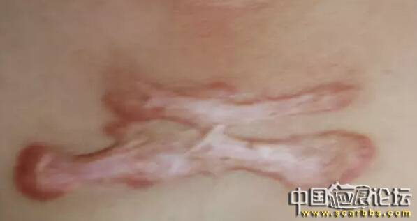 疤痕體質(zhì)的具體危害以及判斷方法[tag]