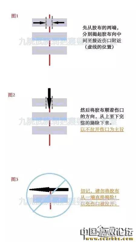 正確使用減張膠布的具體方法分享[tag]
