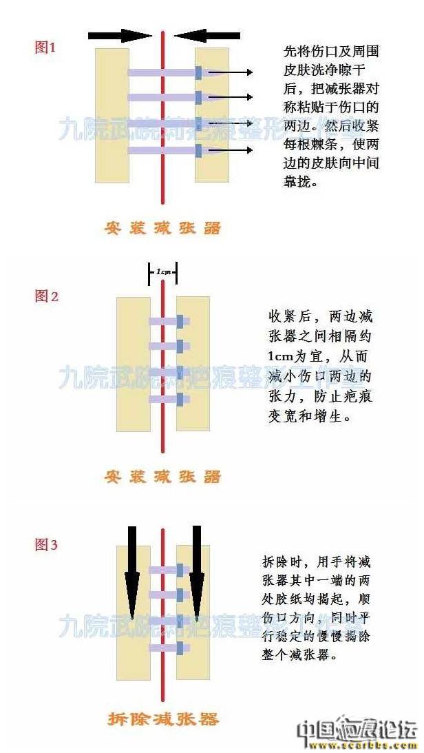 疤痕減張?zhí)幚矸椒ㄖ疁p張器使用詳解[tag]
