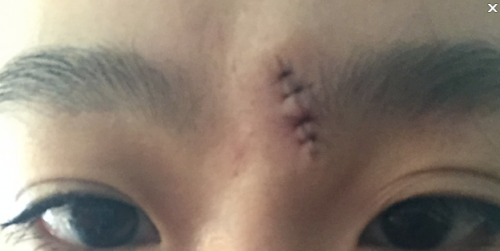 祛痣縫四針后手術(shù)疤痕怎么修復(fù)？[tag]