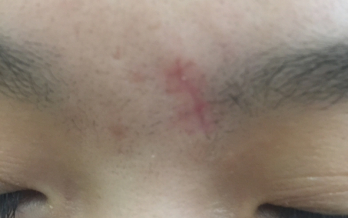 祛痣縫四針后手術(shù)疤痕怎么修復(fù)？[tag]