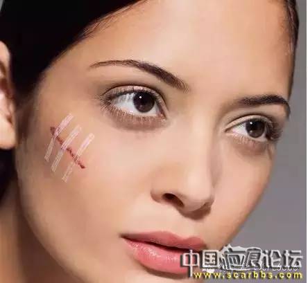 美容手術(shù)之后避免疤痕增生的方法介紹[tag]