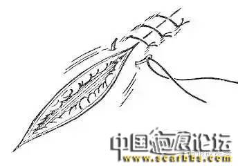 詳細(xì)圖解各種疤痕手術(shù)縫合的具體方法[tag]