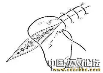 詳細(xì)圖解各種疤痕手術(shù)縫合的具體方法[tag]