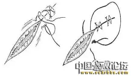 詳細(xì)圖解各種疤痕手術(shù)縫合的具體方法[tag]
