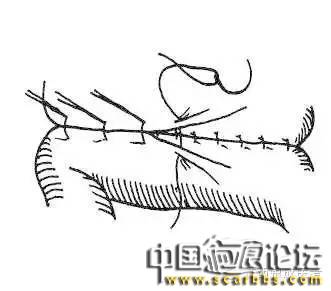 詳細(xì)圖解各種疤痕手術(shù)縫合的具體方法[tag]