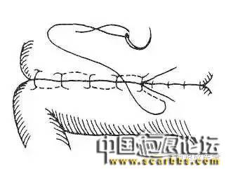 詳細(xì)圖解各種疤痕手術(shù)縫合的具體方法[tag]