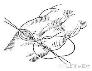 詳細(xì)圖解各種疤痕手術(shù)縫合的具體方法[tag]