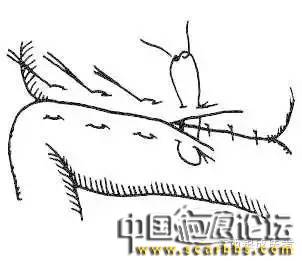 詳細(xì)圖解各種疤痕手術(shù)縫合的具體方法[tag]