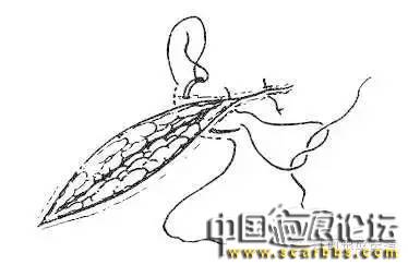 詳細(xì)圖解各種疤痕手術(shù)縫合的具體方法[tag]
