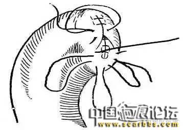 詳細(xì)圖解各種疤痕手術(shù)縫合的具體方法[tag]