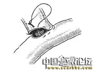 詳細(xì)圖解各種疤痕手術(shù)縫合的具體方法[tag]