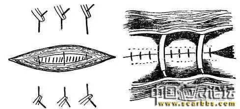 詳細(xì)圖解各種疤痕手術(shù)縫合的具體方法[tag]
