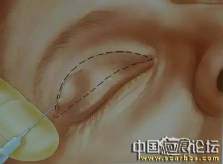 美容手術(shù)之雙眼皮手術(shù)詳細圖示分享[tag]