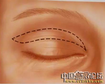 美容手術(shù)之雙眼皮手術(shù)詳細圖示分享[tag]