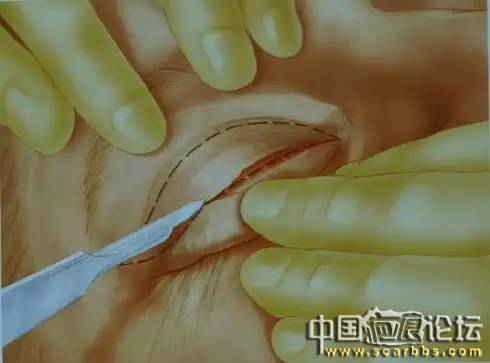 美容手術(shù)之雙眼皮手術(shù)詳細圖示分享[tag]