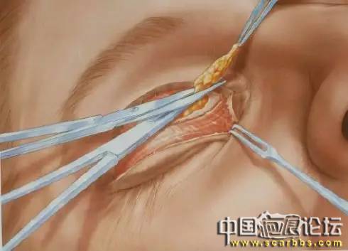 美容手術(shù)之雙眼皮手術(shù)詳細圖示分享[tag]