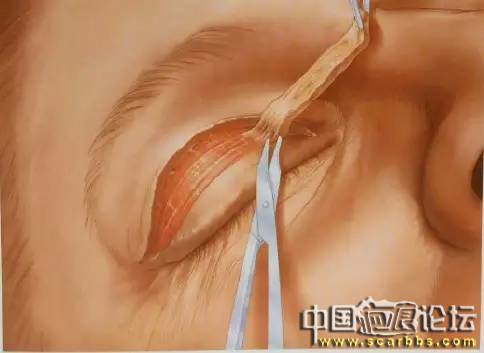 美容手術(shù)之雙眼皮手術(shù)詳細圖示分享[tag]