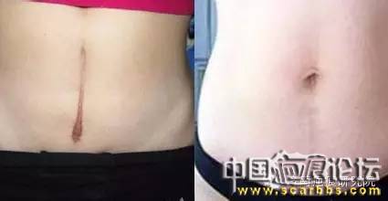 治療剖腹產(chǎn)疤痕三招就可搞定[tag]