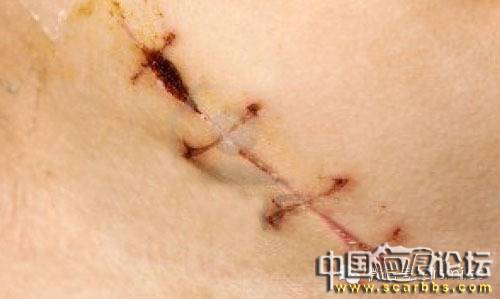 淺析外傷后的傷口縫合技術(shù)的重要性[tag]