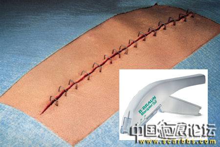 淺析外傷后的傷口縫合技術(shù)的重要性[tag]