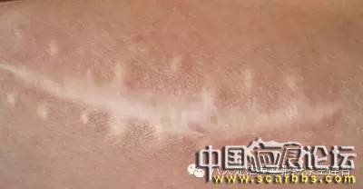 有疤痕一定就屬于疤痕體質(zhì)嗎？[tag]