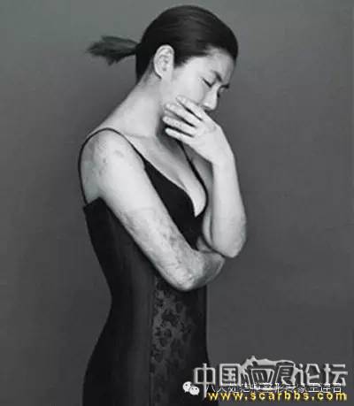 有疤痕一定就屬于疤痕體質(zhì)嗎？[tag]