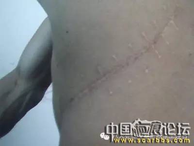 有疤痕一定就屬于疤痕體質(zhì)嗎？[tag]