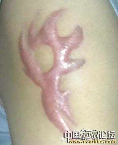 有疤痕一定就屬于疤痕體質(zhì)嗎？[tag]