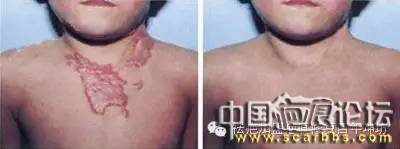 如何才能避免燒燙傷疤痕增生的情況出現(xiàn)？[tag]