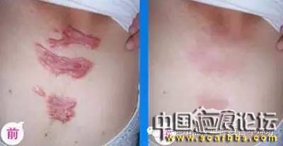 如何才能避免燒燙傷疤痕增生的情況出現(xiàn)？[tag]