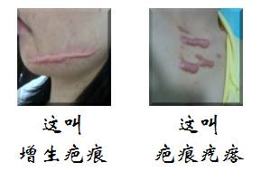 如何才能鑒定自己是不是屬于疤痕體質？[tag]