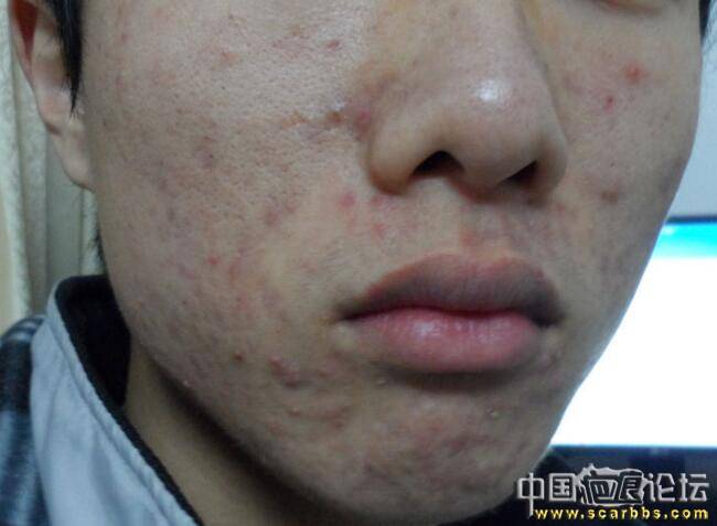 青春痘（痤瘡）可以通過中藥來治療的[tag]