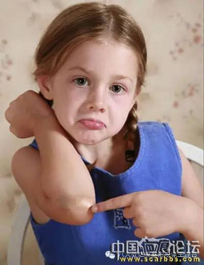 外傷疤痕的正確處理方法分享[tag]