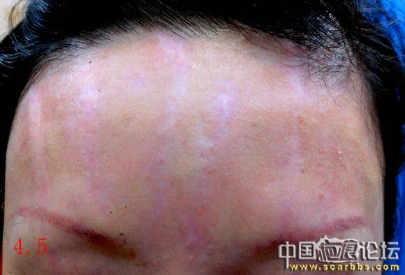 看看《疤痕自然化生法》是如何讓“脫色白斑”恢復(fù)正常皮膚的[tag]