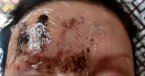 看看《疤痕自然化生法》是如何讓“脫色白斑”恢復(fù)正常皮膚的[tag]