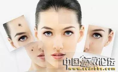 長痣的原因以及祛痣的正確處理方法分享[tag]