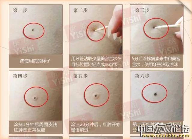 長痣的原因以及祛痣的正確處理方法分享[tag]