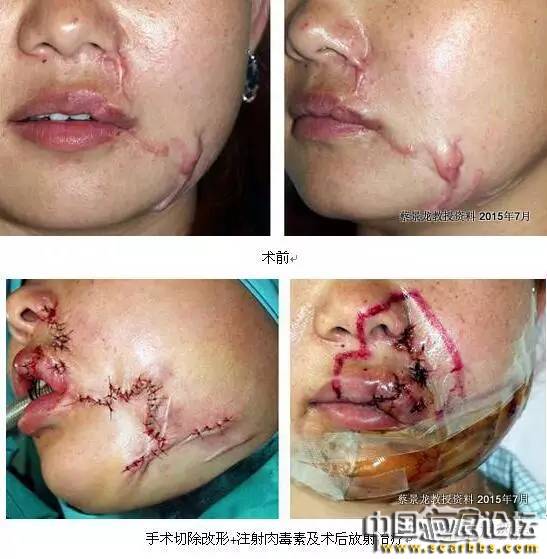 對(duì)于瘢痕疙瘩系統(tǒng)治療的新思路分享[tag]