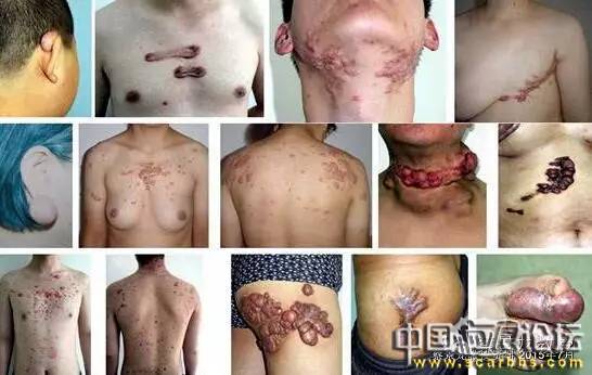 對(duì)于瘢痕疙瘩系統(tǒng)治療的新思路分享[tag]