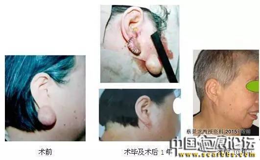 對(duì)于瘢痕疙瘩系統(tǒng)治療的新思路分享[tag]