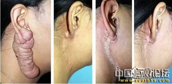 對(duì)于瘢痕疙瘩系統(tǒng)治療的新思路分享[tag]