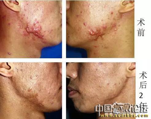 對(duì)于瘢痕疙瘩系統(tǒng)治療的新思路分享[tag]