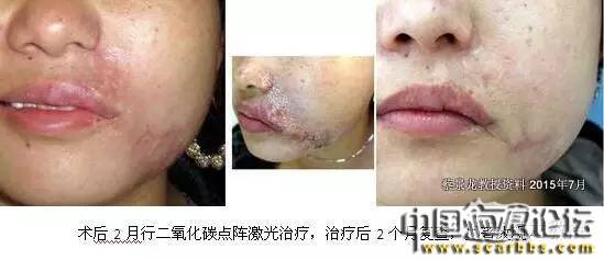 對(duì)于瘢痕疙瘩系統(tǒng)治療的新思路分享[tag]