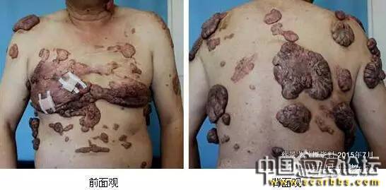 對(duì)于瘢痕疙瘩系統(tǒng)治療的新思路分享[tag]