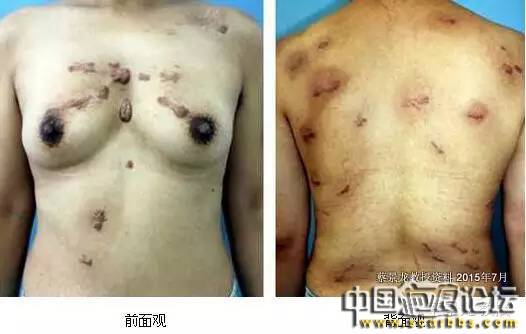 對(duì)于瘢痕疙瘩系統(tǒng)治療的新思路分享[tag]